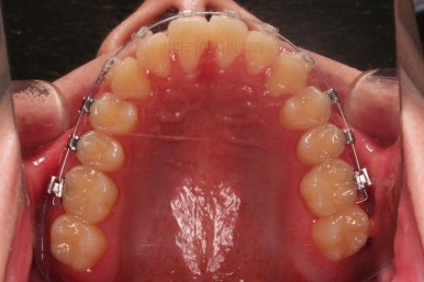 부산주걱턱교정