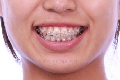 부산연산역치아교정