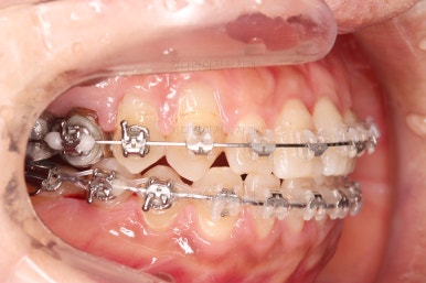 부산연산동교정치과