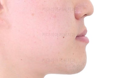 부산비수술교정