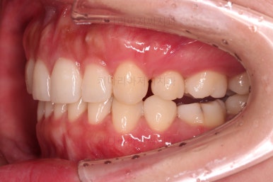 부산인비절라인