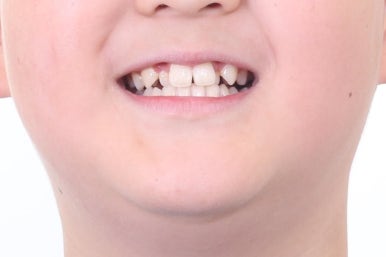 부산비발치교정