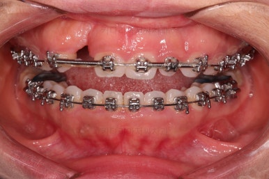 부산구순구개열