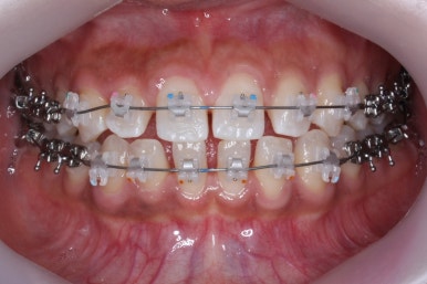 부산치아교정치과