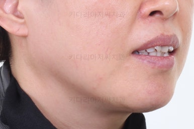 동래임플란트교정