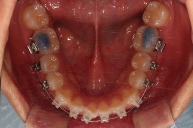 부산비발치교정