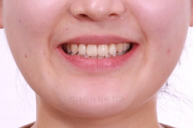 부산치아교정