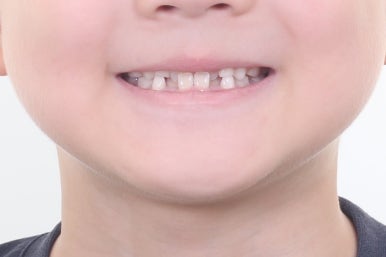 부산어린이치아교정