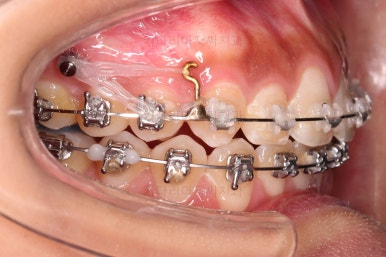 부산치아교정치과