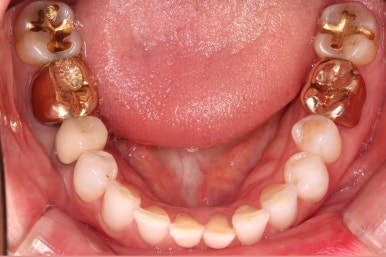 연산동부분교정