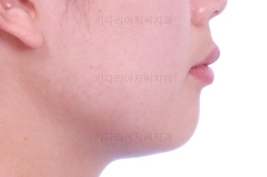 부산앞니부분교정