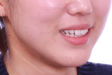 부산치아교정잘하는곳