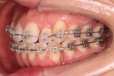 부산비발치교정