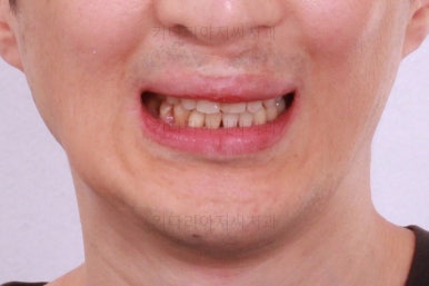 부산구순구개열교정