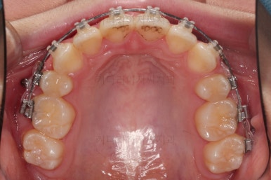 연산동치아교정