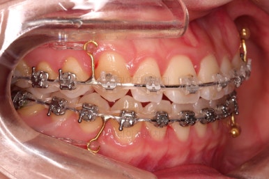 부산치아교정잘하는곳
