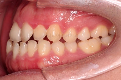 부산긴얼굴긴턱교정