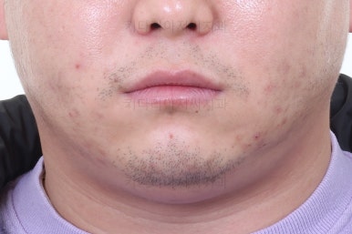 연산동임플란트