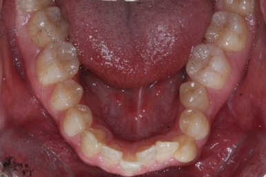 부산구순구개열