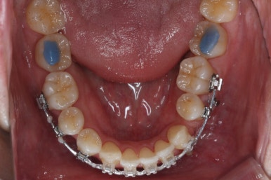 부산비수술교정