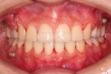 부산클리피씨교정