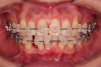 동래임플란트교정
