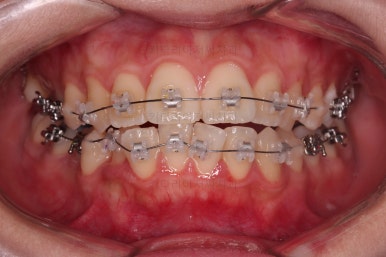 부산클리피씨교정