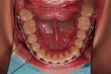 부산연산역치아교정