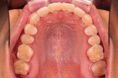 부산연산역치아교정