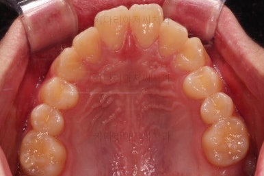 부산연산동사랑니발치