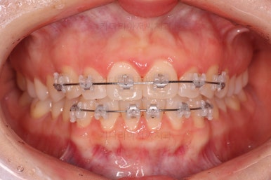 부산나비앞니교정