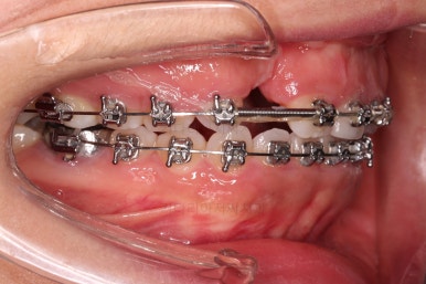 부산구순구개열