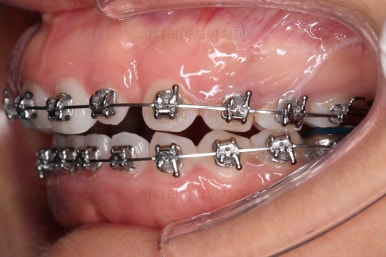 부산구순구개열