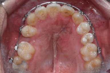 부산구순구개열