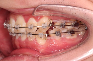 부산돌출입교정
