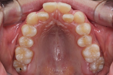 부산비발치교정