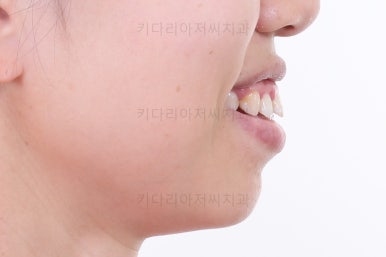 부산치아교정