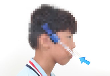 연산동덧니교정