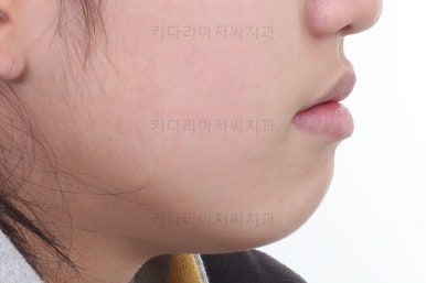 부산치아교정전문의