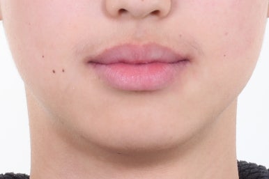 부산치아교정전문의