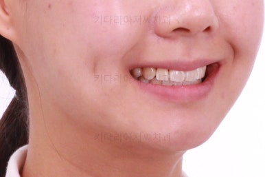 부산치아교정잘하는치과