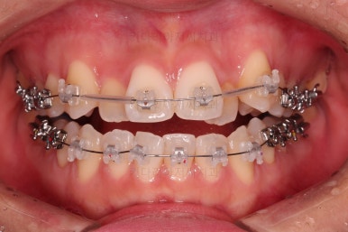 부산비발치교정