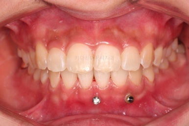 부산앞니부분교정