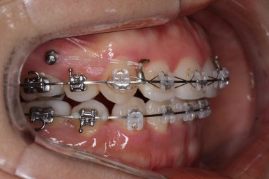 부산연산동교정치과