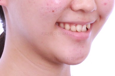 부산비발치교정