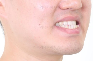 부산비수술교정
