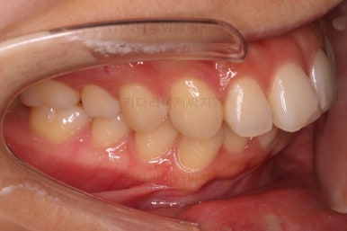 부산연산동교정치과