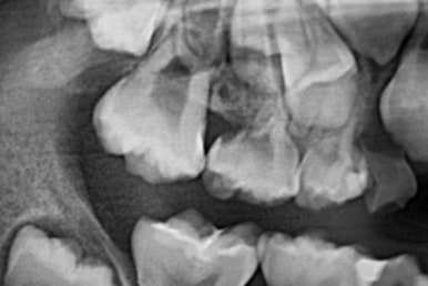 부산어린이치아교정