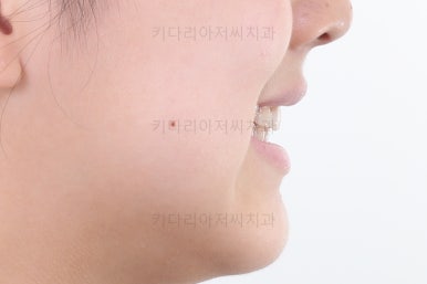 부산토끼치아교정