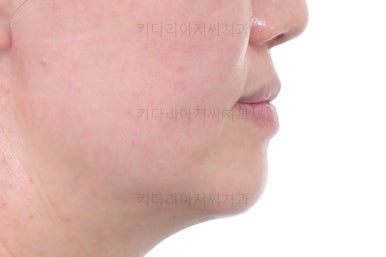 부산치아교정잘하는곳